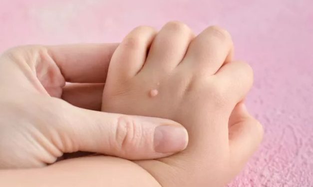 Bentolan Kutil Pada Kulit Di Tubuh Manusia