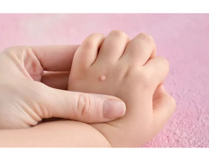 Bentolan Kutil Pada Kulit Di Tubuh Manusia