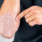 Keadaan Kronis Pada Penderita Kulit Psoriasis