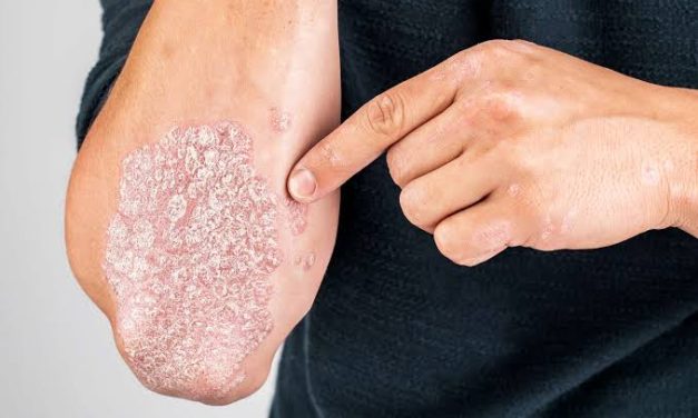 Keadaan Kronis Pada Penderita Kulit Psoriasis