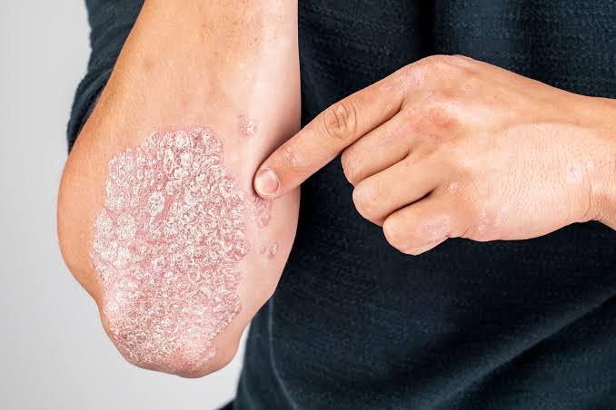 Keadaan Kronis Pada Penderita Kulit Psoriasis